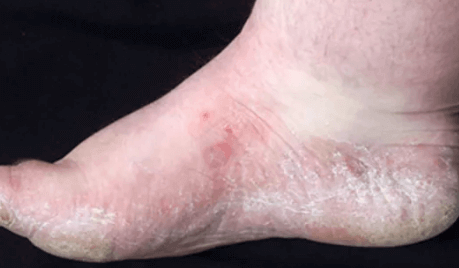 How Athlete’s Foot Pictures Help You With This Disease?